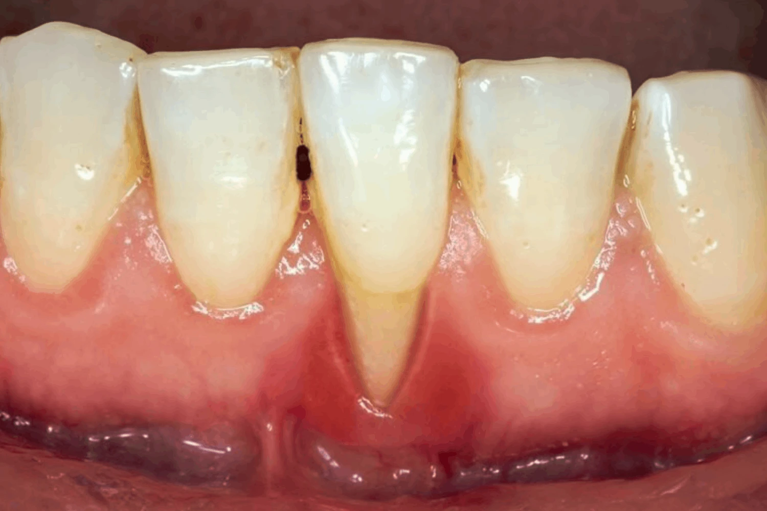 Bọc răng sứ bị tụt lợi không khó để nhận biết